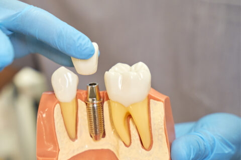 Dental Implant Kits Manufacturer
